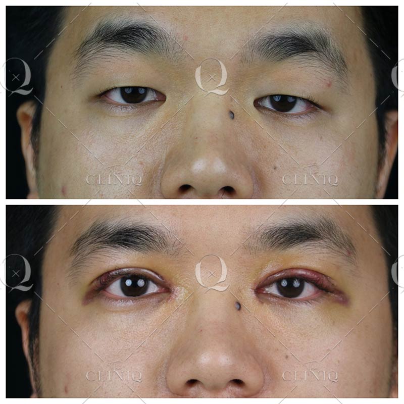 Antes y después blefaroplastia asiáticos.