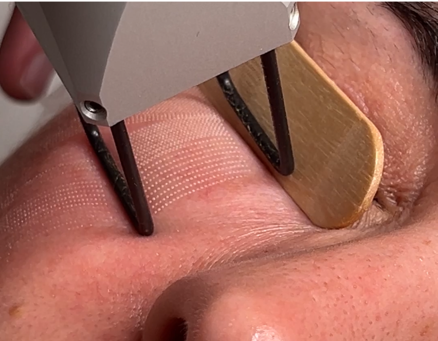 resurfacing periocular